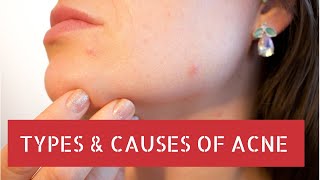 7 Types of Acne Scars | What Causes Acne Scars? | Treatment for Acne