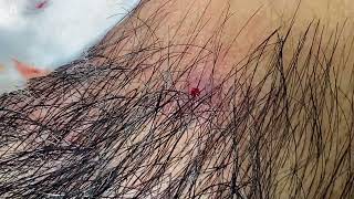 Big Cystic Acne Blackheads Extraction Blackheads & Milia, Whiteheads Removal Pimple Popping