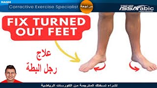 علاج رجل البطة  ال feet turn out