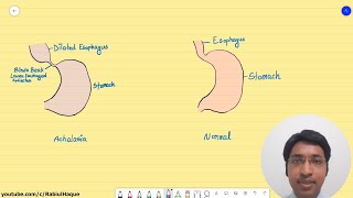 Achalasia Full HD