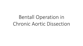 Bentall Operation in Chronic Aortic Dissection | Open Heart Surgery