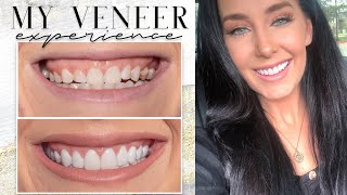 Porcelain Veneers & Gum Contouring | My Detailed Experience with Vlog Footage | Pain, Cost, & Why