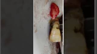 Tooth Removal | Broken Tooth #shorts #dental #dentalsurgeon #dentist #youtubeshorts