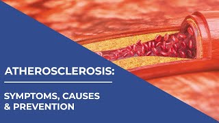 Atherosclerosis: Know the Symptoms, Causes & Prevention | Arteries | Healthie Genie