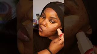 No foundation makeup on acne scarring & hyperpigmentation, full video on my channel 🤍 #makeup #acne