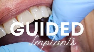 Guided Implant Placement with Dr. Vasquez & TruAbutment 🦷