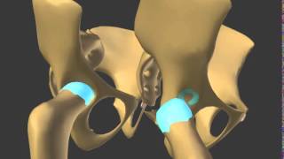 dislocation in congenital dysplasia of the hip