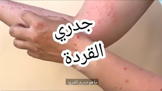 #معلومات هامة عن جدري القردة يجب معرفتها  .