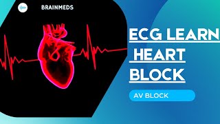 The ECG Course   AV Blocks Easy Learning ECG AV blocks