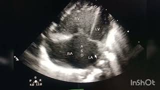 arch ,aorta and LA and LV before and after the repair