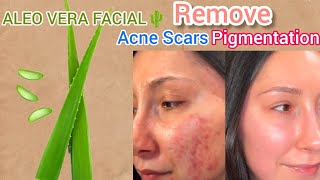 Aleo Vera Gel Facial🌵! Remove acne scars pigmentation💕.#aleovera #acnescars