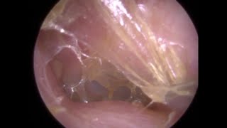 Ear Wax and Keratin Removal in 'Surfer's' Ear Left Ear