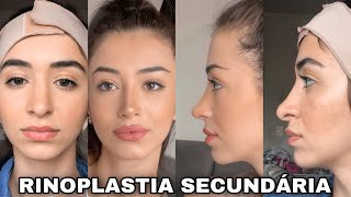 MINHA RINOPLASTIA SECUNDÁRIA