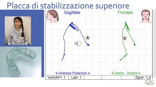 Bite dentali a confronto