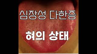 심장의 원인으로 발생한 다한증 환자들의 혀의 상태