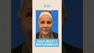 Facelift, Necklift, and Upper Blepharoplasty✨