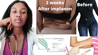 The Implanon sucks| Contraceptive weight gain| My experience | South African youtuber