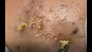 Acne clear - Blackhead removal - Beauty care video #57