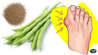 Remove Uric Acid From Body And Relieve Gout Pain / Joint Pain