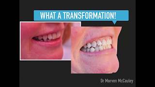 Watch Your Teeth Transform With Enlighten Tooth Whitening