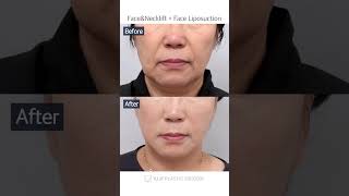 [B&A] Face&Necklift+Face Liposuction at V.LIF Plastic Surgery Clinic in Korea #shorts