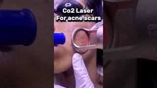 Acne scars treatment - Co2 Laser #skincare #skincenter #acnescars #co2laser #pimplemarks #beauty