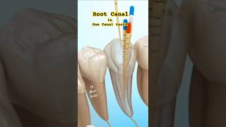 Root Canal in One Canal tooth or 4 Canals