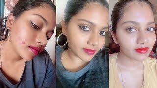 Pimples treatment at Home Guidelines | Best home remedy for Acne overnight during Lockdown 4.0