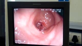 esophageal varices on OGDscopy/ Upper GIscopy