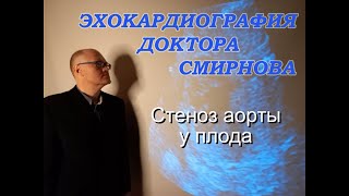 6. Стеноз аорты у плода (Aortic stenosis in fetus)