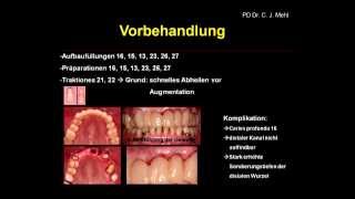 Umfassende Zahnbehandlung mit Implantaten, Knochenaufbau, Kronen, Brücken und Veneers