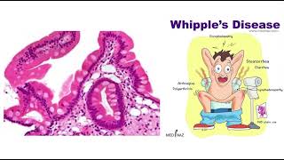 Whipple disease | GIT systemic path | USMLE