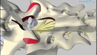 Dorsal view of lumbosacral distraction stabilisation surgical technique