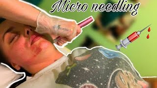 My Micro Needling Experience VLOG first time having micro needling