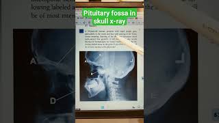 Skull X-ray : Pituitary fossa #shorts