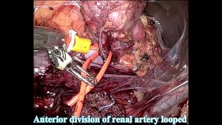 #280  Robotic Repair of Renal Arterio-Venous Malformation-Dr. Sanjoy Sureka