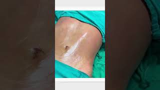 Amazing Results For Vaser Liposuction | التحول المذهل لشفط الدهون بالفيزر