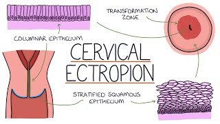 Understanding Cervical Ectropion / Cervical Erosion