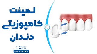 لمینت کاپوزیتی دندان ❌