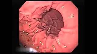 VIDEOENDOSCOPIA NORMAL SL