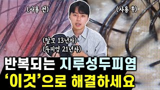 의사인 제가 지루성 두피염, 탈모를 극복할 수 있었던 비밀 아이템 (feat. 효과 보장, 최초공개)