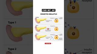 Type of Diabetes #csirnetjrf #csirnet #lifesciencestudents