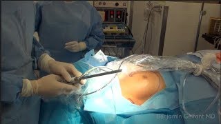 Dr. Gelfant demonstrates: Endoscopic Breast Augmentation