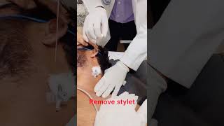 تركيب كانيولا في jugular vein