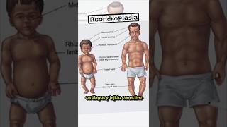 Acondroplasia, la causante del enanismo 🩻