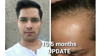 My 10.5 months Minoxidil Finasteride Short Update ||Receding Hairline regrowth|Hair fall stop