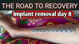 Implant Removal Day 8 || The Road To Recovery || Tibia Fibula Fracture Recovery