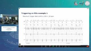 Biotronik CRT Features Optimization Overview   Ibrahim M  Ibrahim