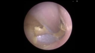 Fungal Infected Dead Skin Peeled off Eardrum