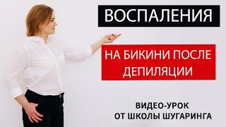 Воспаления на бикини после депиляции. Вросшие волосы на бикини. Шугаринг бикини